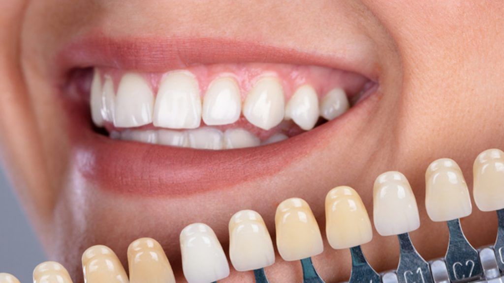 carillas dentales