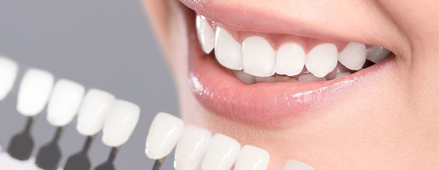 Carillas dentales
