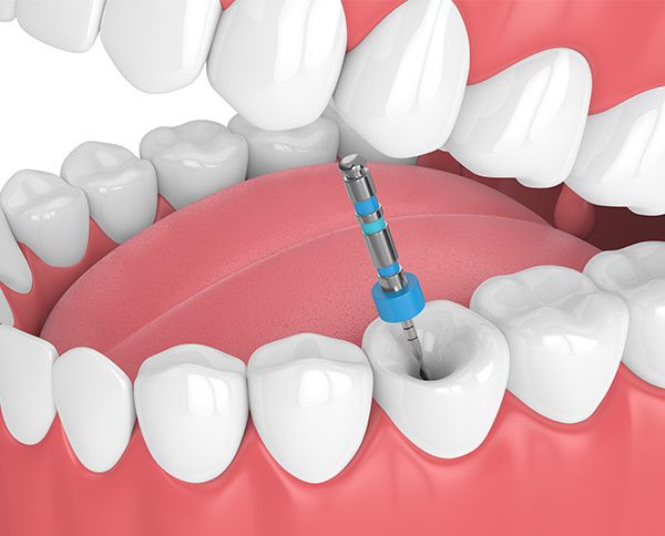 Endodoncias