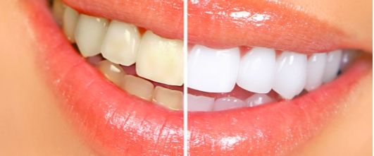 dientes blancos antes y después