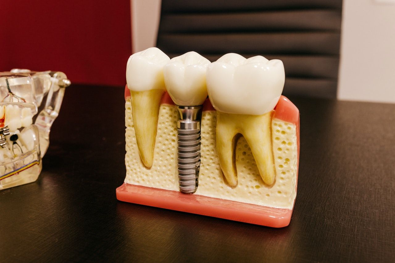 ¿Te van a poner un implante dental? Presta atención