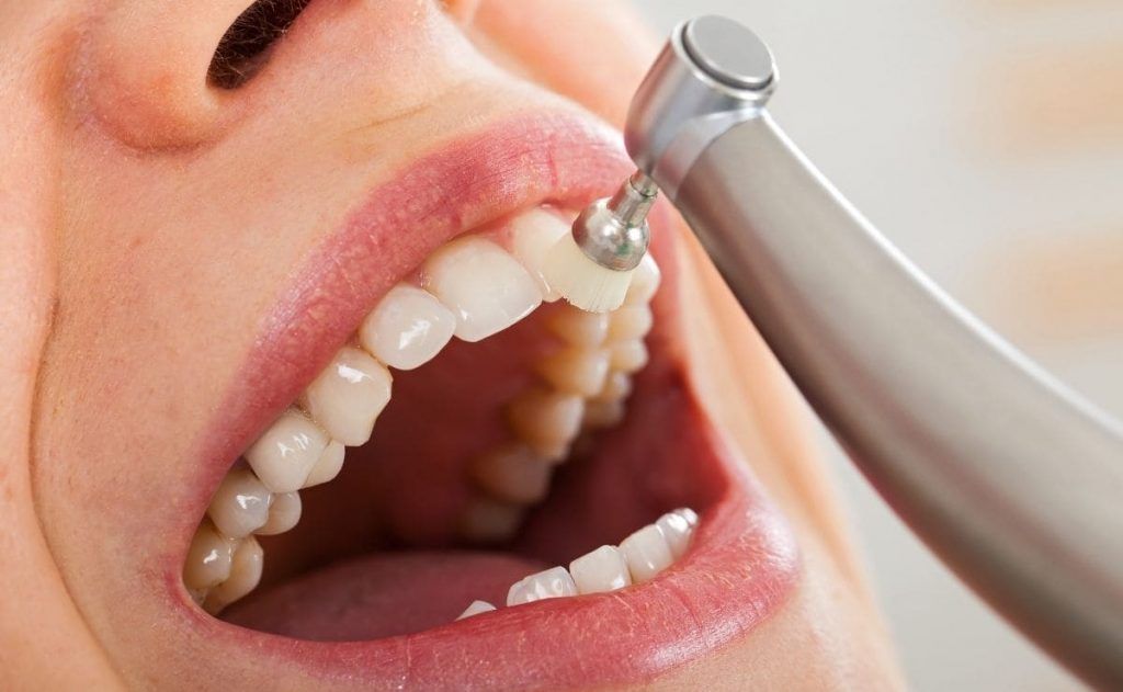 diferencia entre raspado y limpieza dental
