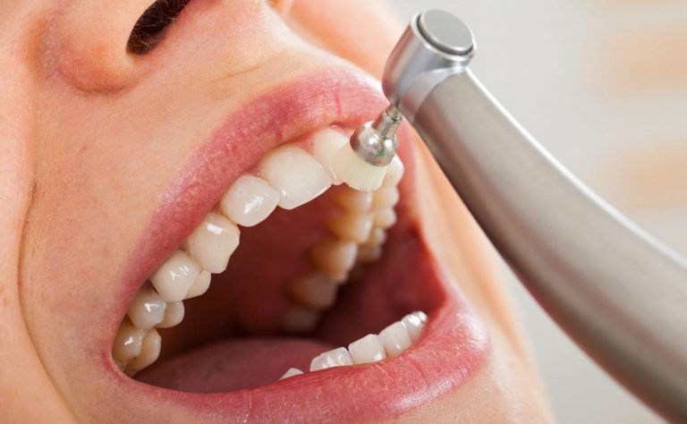 diferencia entre raspado y limpieza dental