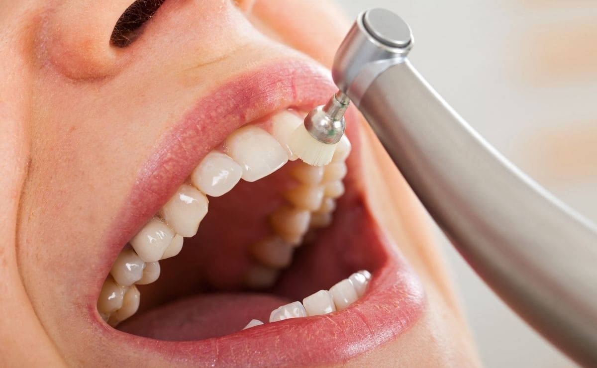 Diferencia entre raspado y limpieza dental