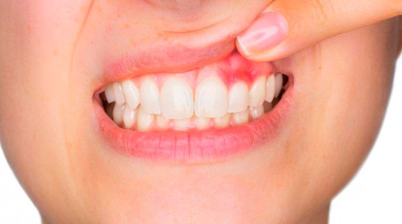 tratamiento periodontal
