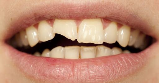 traumatismo dental