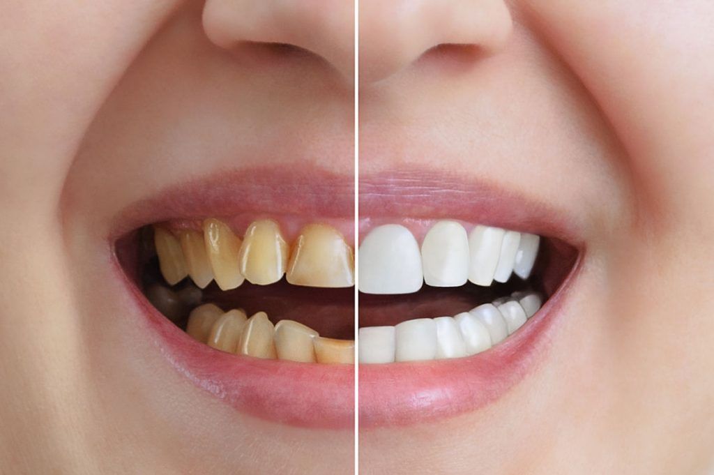 carillas dentales