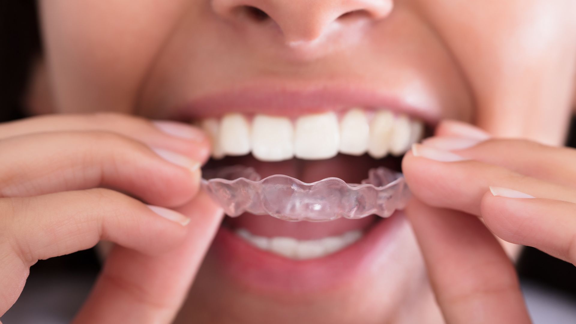 ¿Cuántos tipos de Invisalign hay?