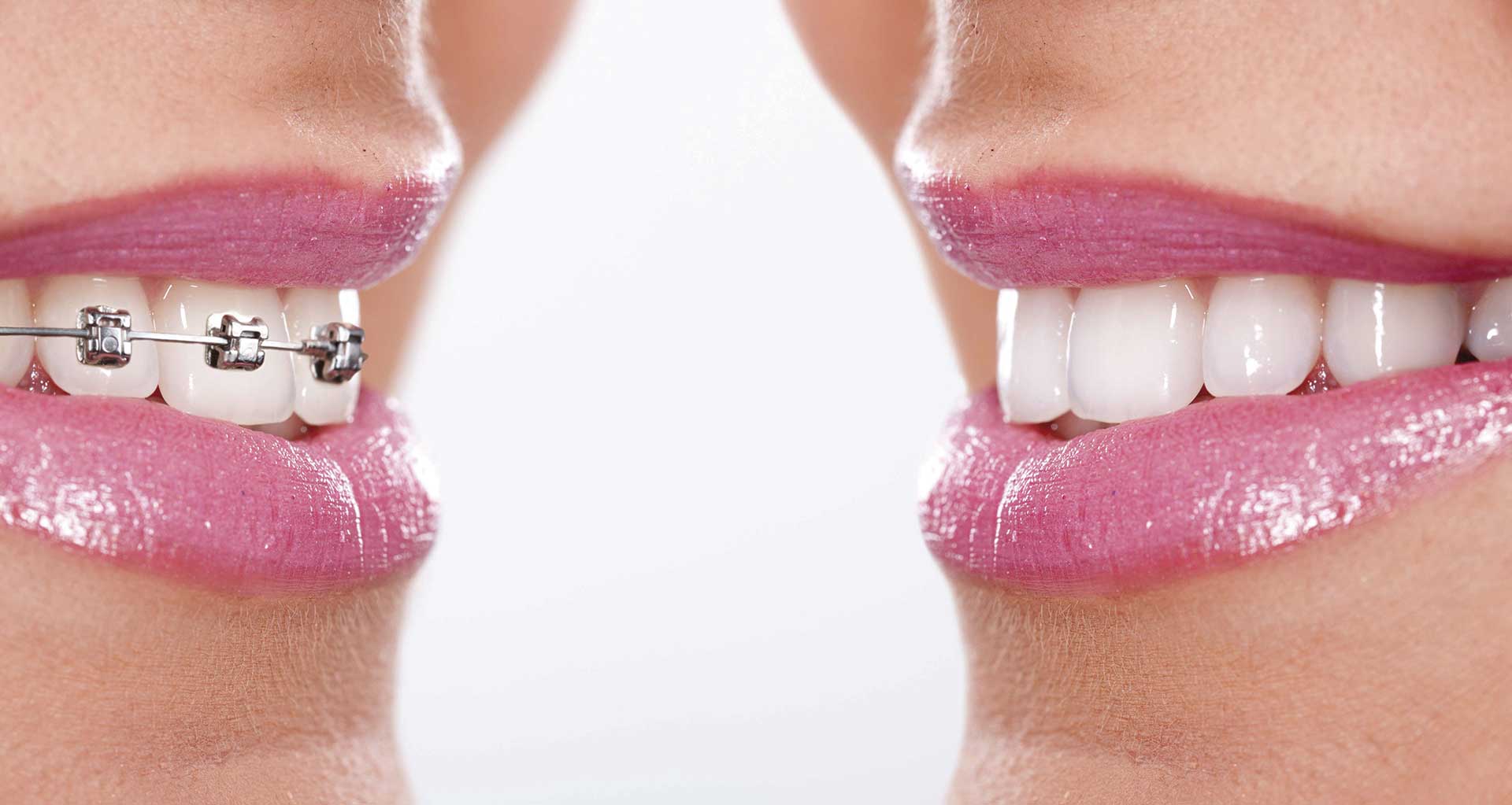 ¿Qué es mejor usar brackets o Invisalign?